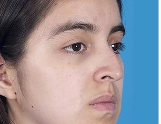 Rhinoplasty Before & After Patient #8807