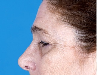 Blepharoplasty Before & After Patient #8533