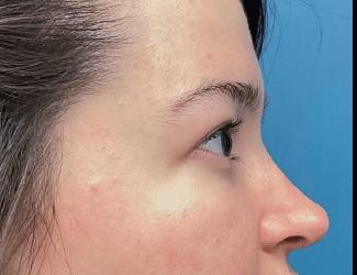 Blepharoplasty Before & After Patient #8485