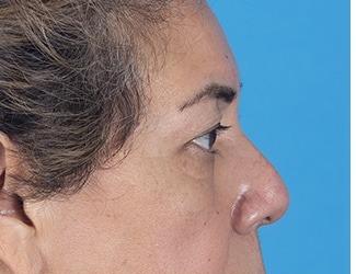 Blepharoplasty Before & After Patient #8482