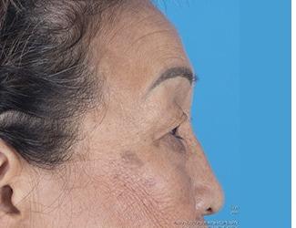 Blepharoplasty Before & After Patient #8478
