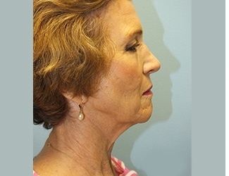 Facial Fat Grafting Before & After Patient #8745