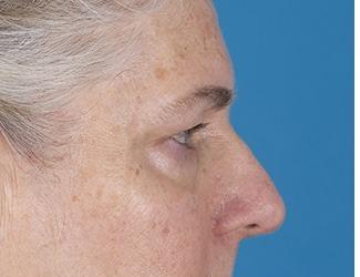 Facial Fat Grafting Before & After Patient #8744