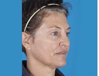 Facial Fat Grafting Before & After Patient #8742