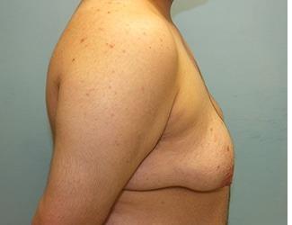 Female to Male Before & After Patient #8442