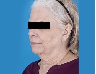 Facial Fat Grafting Before & After Patient #8740