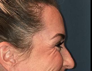 Botox Before & After Patient #8821