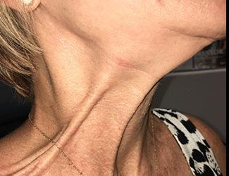 Botox Before & After Patient #8820