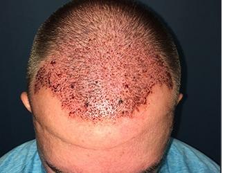 NeoGraft Before & After Patient #8827