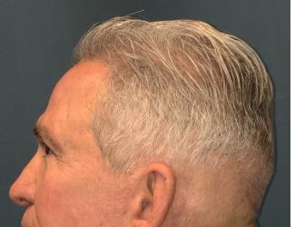 NeoGraft Before & After Patient #8826