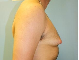 Female to Male Before & After Patient #8440