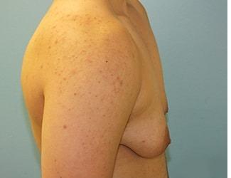 Female to Male Before & After Patient #8444