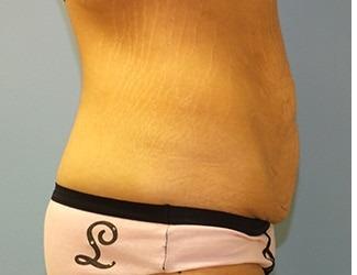 Tummy Tuck Before & After Patient #8197