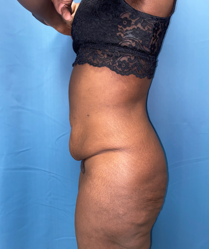 Tummy Tuck Before & After Patient #8204