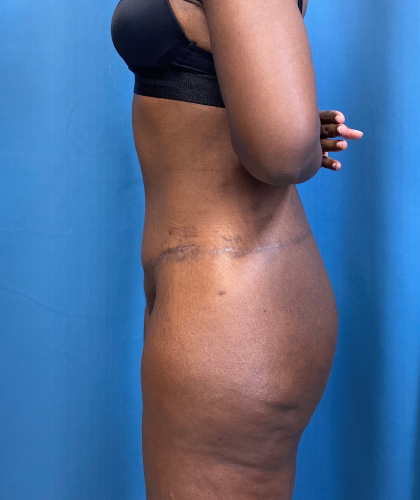 Tummy Tuck Before & After Patient #8204
