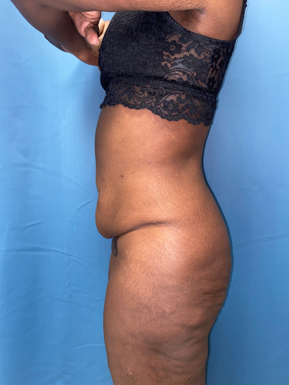 Lower Body Lift Before & After Patient #8029
