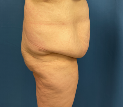 Lower Body Lift Before & After Patient #8028