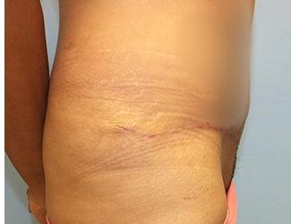 Tummy Tuck Before & After Patient #8199