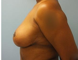 Breast Reduction Before & After Patient #8416