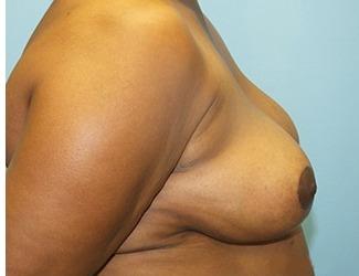 Breast Reduction Before & After Patient #8415