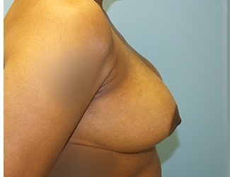 Breast Reduction Before & After Patient #8411