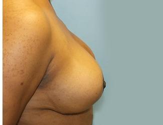 Breast Reduction Before & After Patient #8414