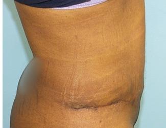 Tummy Tuck Before & After Patient #8195