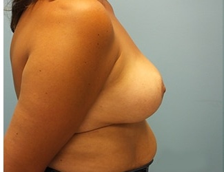 Breast Reduction Before & After Patient #8410