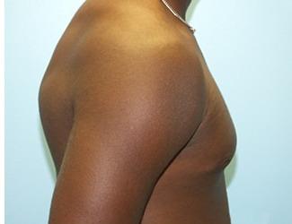 Gynecomastia Before & After Patient #8443