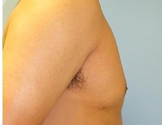 Gynecomastia Before & After Patient #8441