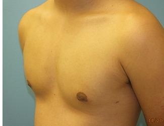 Gynecomastia Before & After Patient #8439