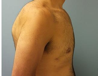 Gynecomastia Before & After Patient #8435