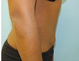 Tummy Tuck Before & After Patient #8192