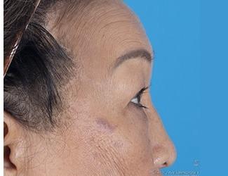 Browlift Before & After Patient #8457