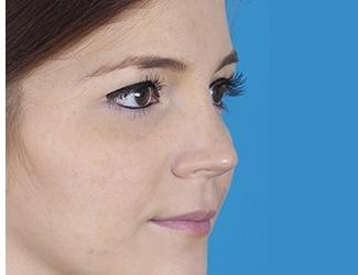 Rhinoplasty Before & After Patient #8809