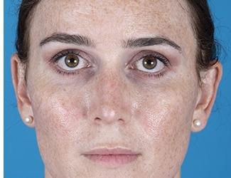 Rhinoplasty Before & After Patient #8808