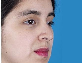 Rhinoplasty Before & After Patient #8807