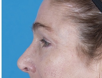 Blepharoplasty Before & After Patient #8533