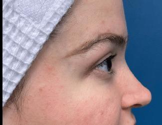 Blepharoplasty Before & After Patient #8485