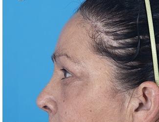 Blepharoplasty Before & After Patient #8484