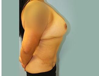 Mommy Makeover Before & After Patient #8019