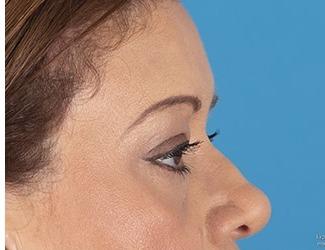 Blepharoplasty Before & After Patient #8481