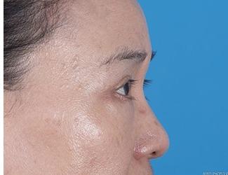 Blepharoplasty Before & After Patient #8483