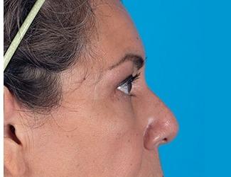 Blepharoplasty Before & After Patient #8482