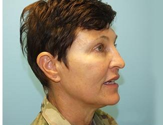 Blepharoplasty Before & After Patient #8480