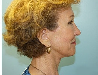 Facial Fat Grafting Before & After Patient #8745