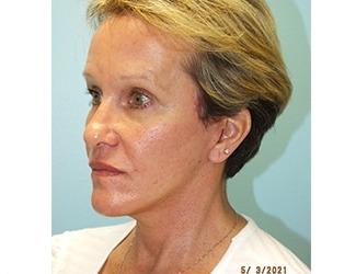 Facial Fat Grafting Before & After Patient #8741