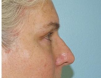 Facial Fat Grafting Before & After Patient #8744