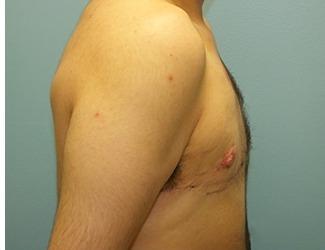 Female to Male Before & After Patient #8442