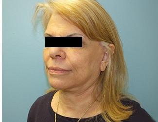 Facial Fat Grafting Before & After Patient #8740